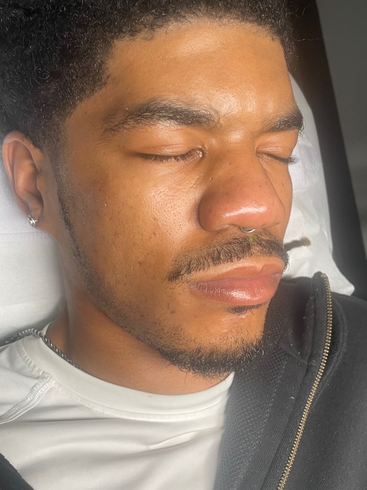 Chemical Peel Facial