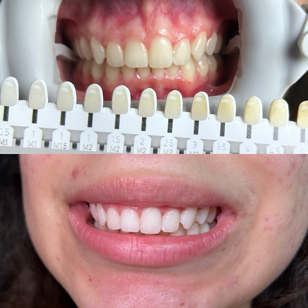 15 Min Teeth Whitening