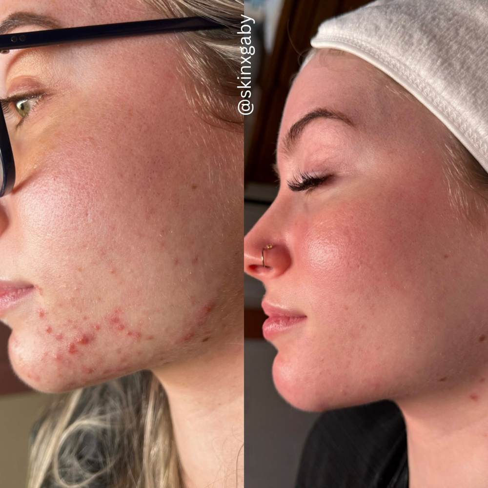 Acne Facial