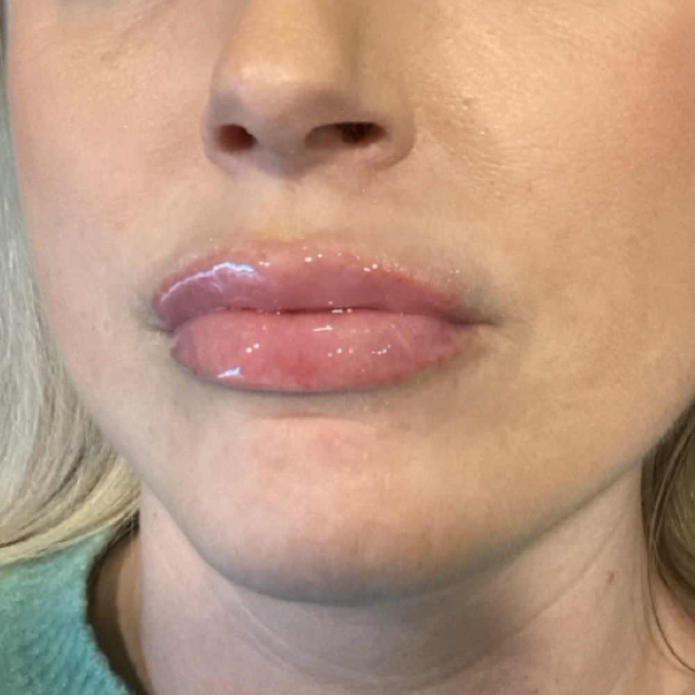Hyaluronic Acid Fillers at Chacing Beauty in Dayton, OH