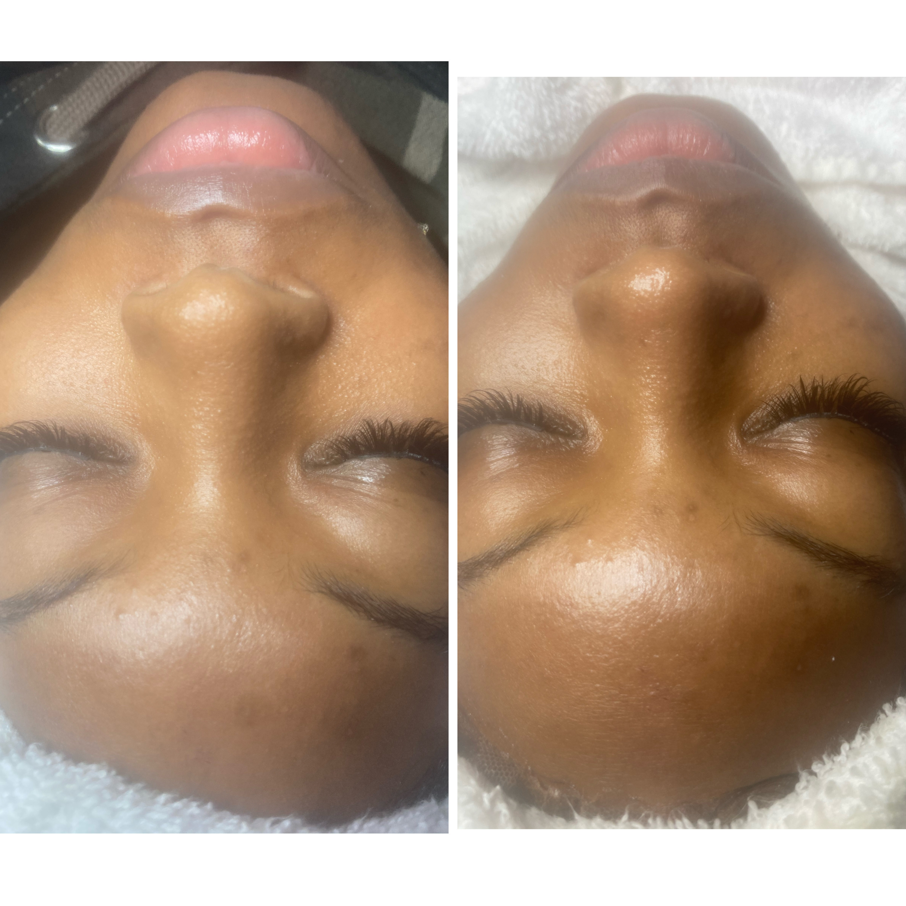 Microdermabrasion
