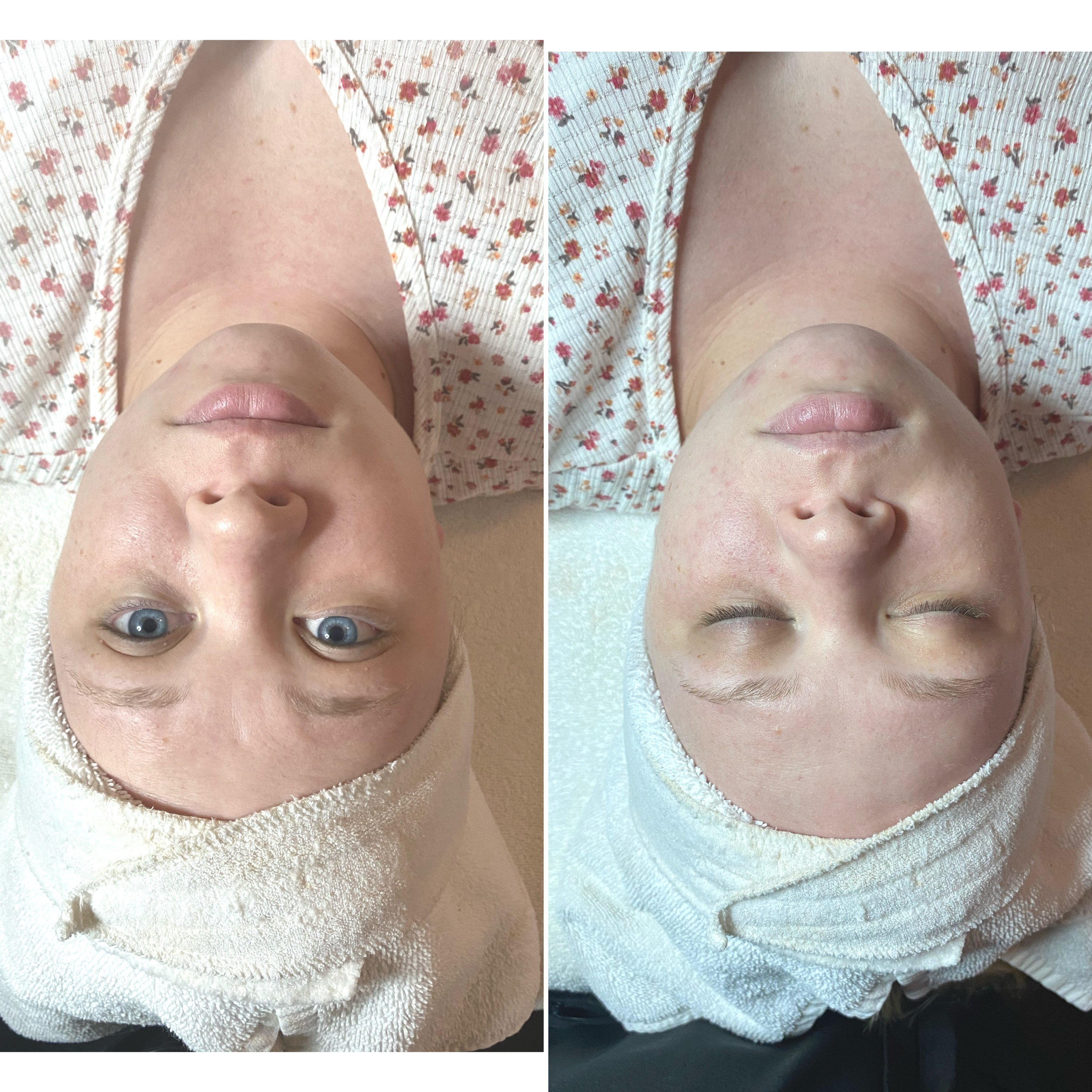 Galvanic (microcurrent) Facial