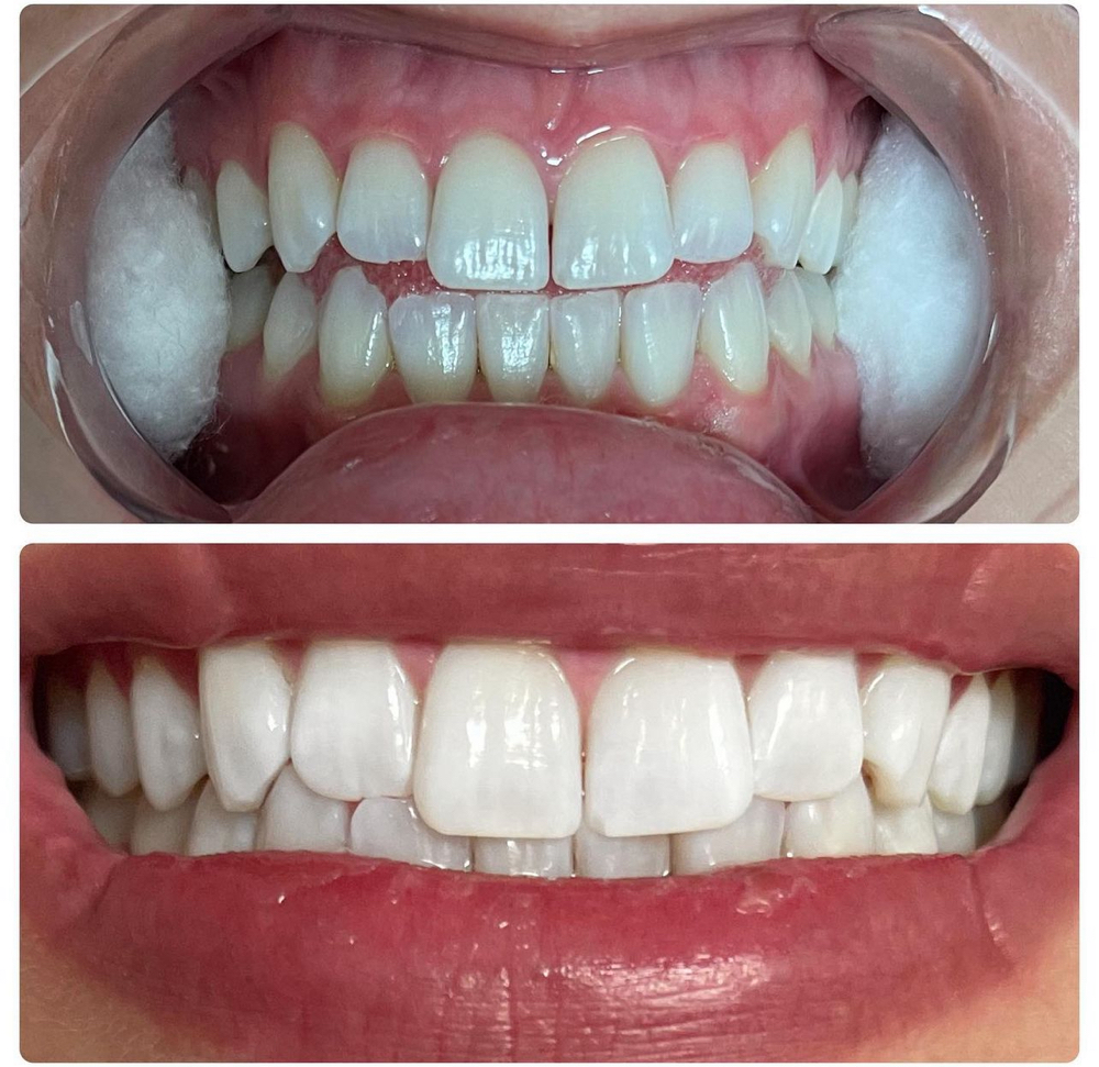 Teeth Whitening (60 min) at Kara Genevieve Beauté in Millersville, MD