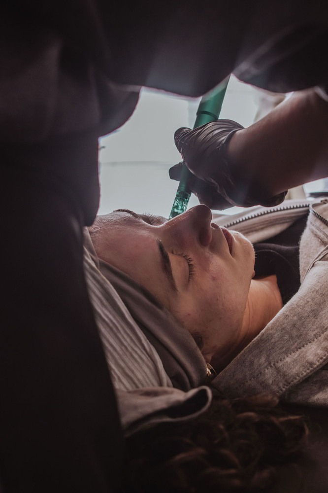 Microneedling