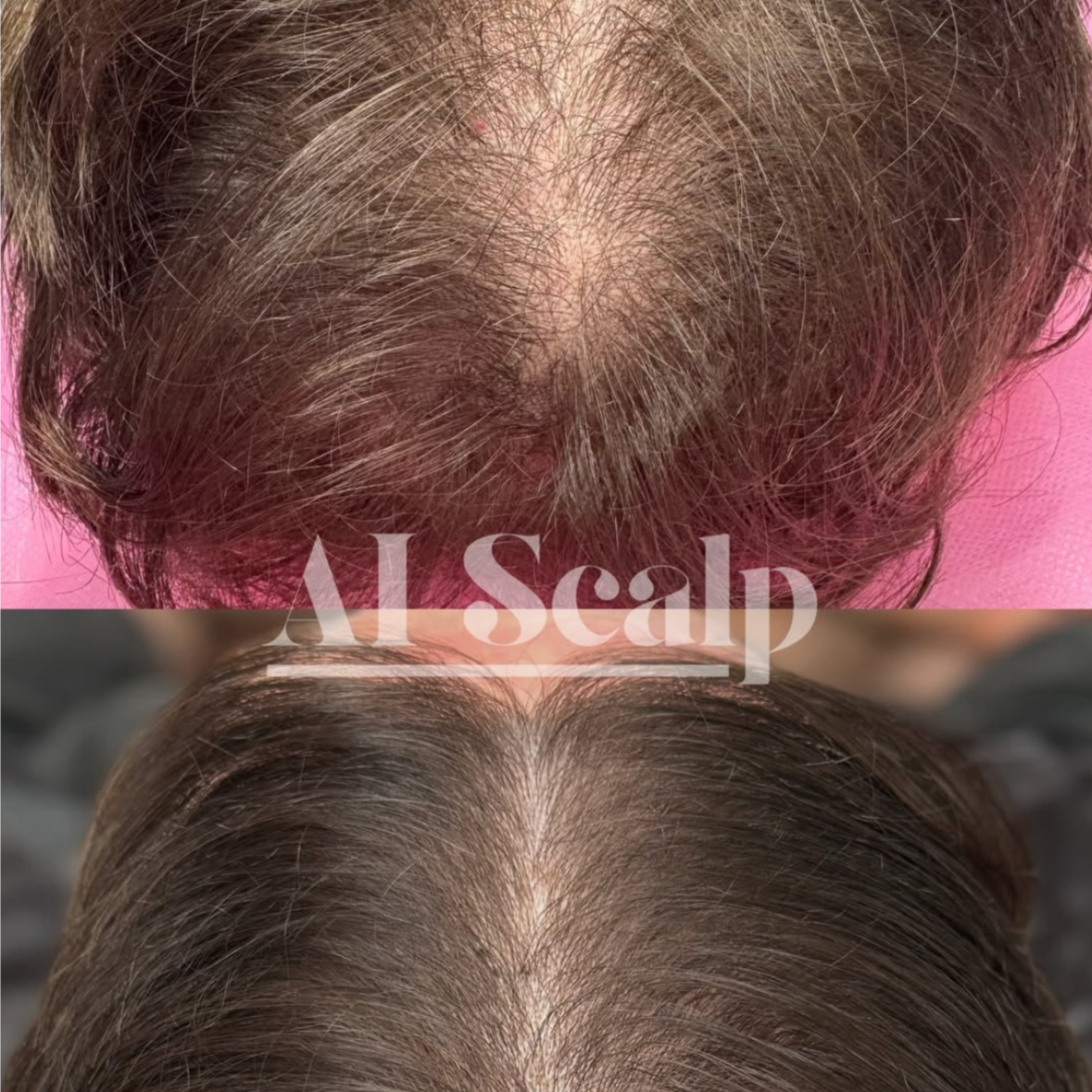 Ai Scalp - 4pk/2-3 zones at Alchemy Haus by Devyn | Color. Extensions. Scalp Density. in Atlanta, GA