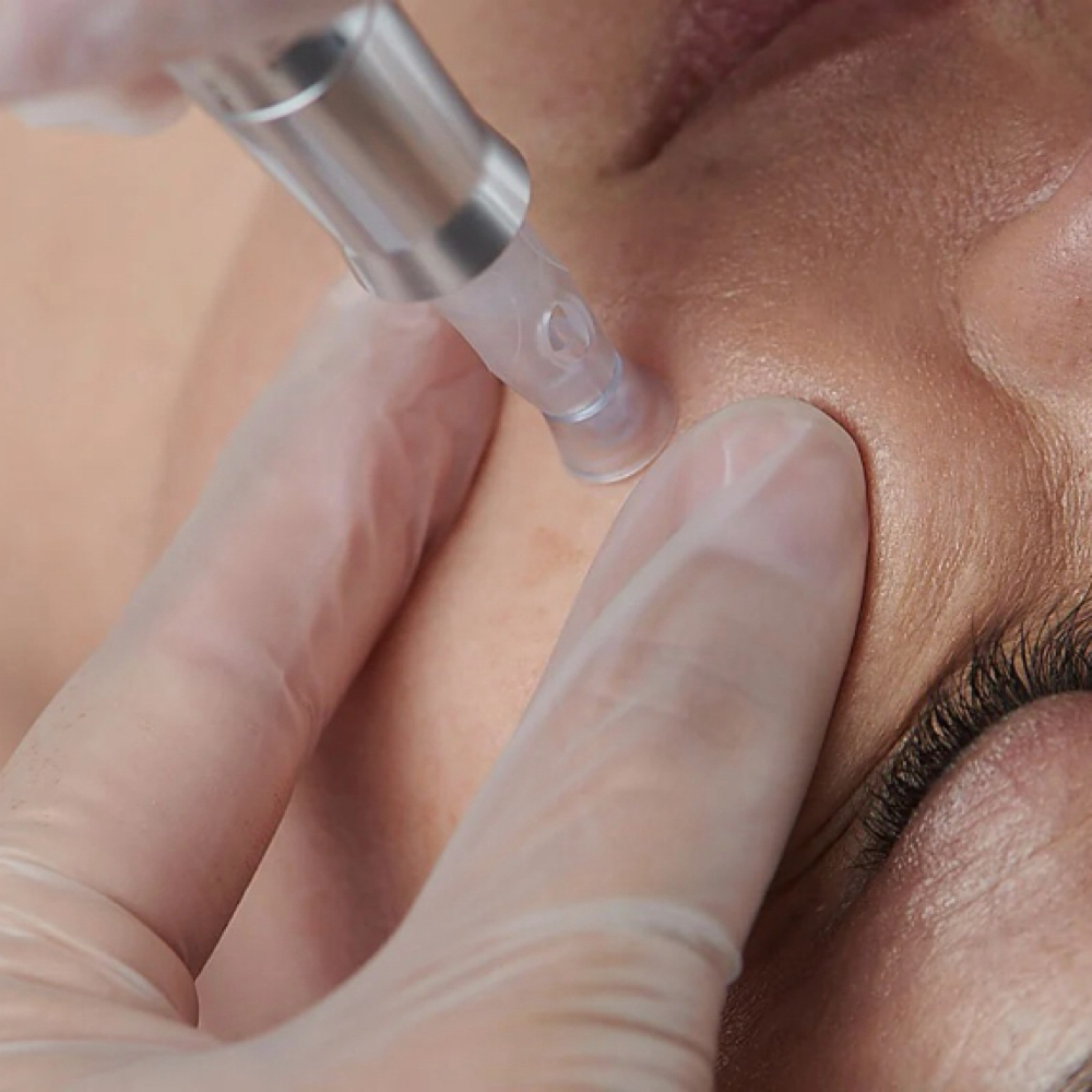 ⭐️Add MicroNeedling To Advanced at Sinful Glow Skin Studio in Fuquay Varina, NC