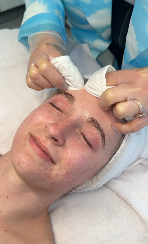 Face Reality Acne Treatments
