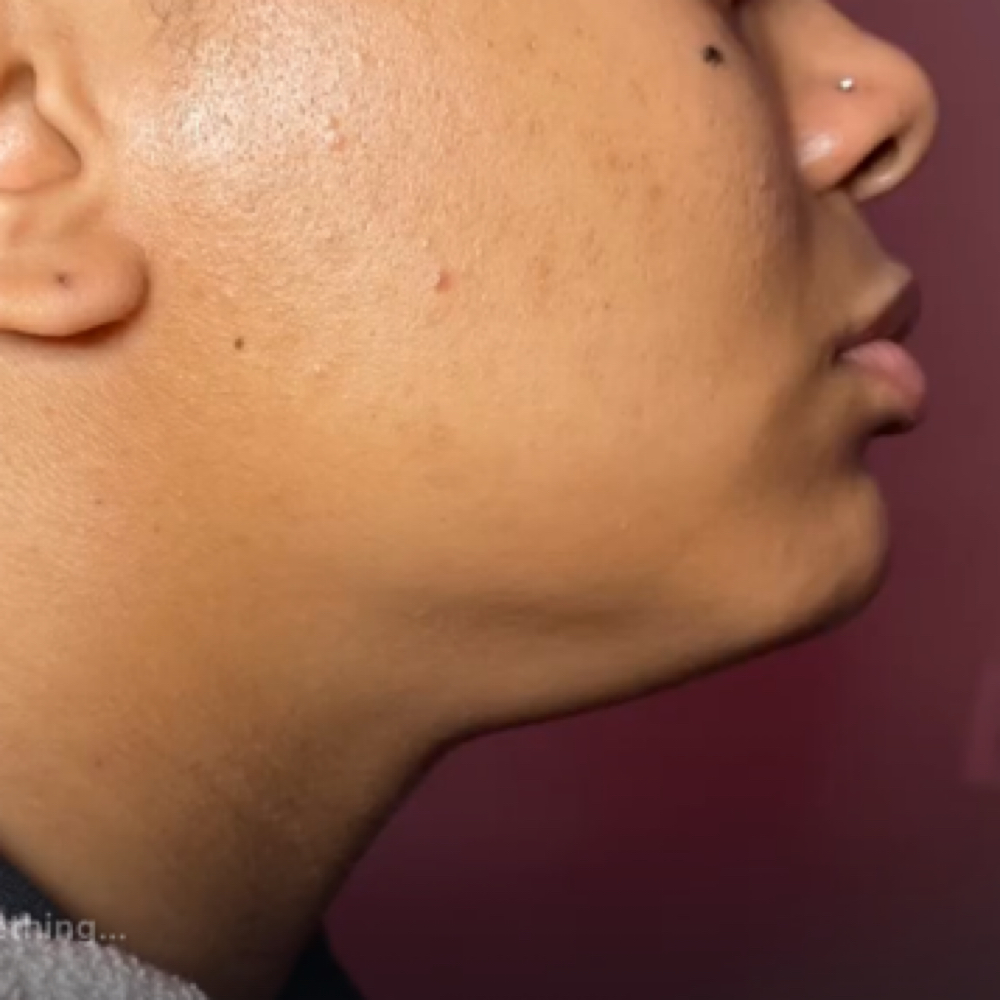 CHIN LIFT at Esthiology Skin Lab in Nottingham, MD