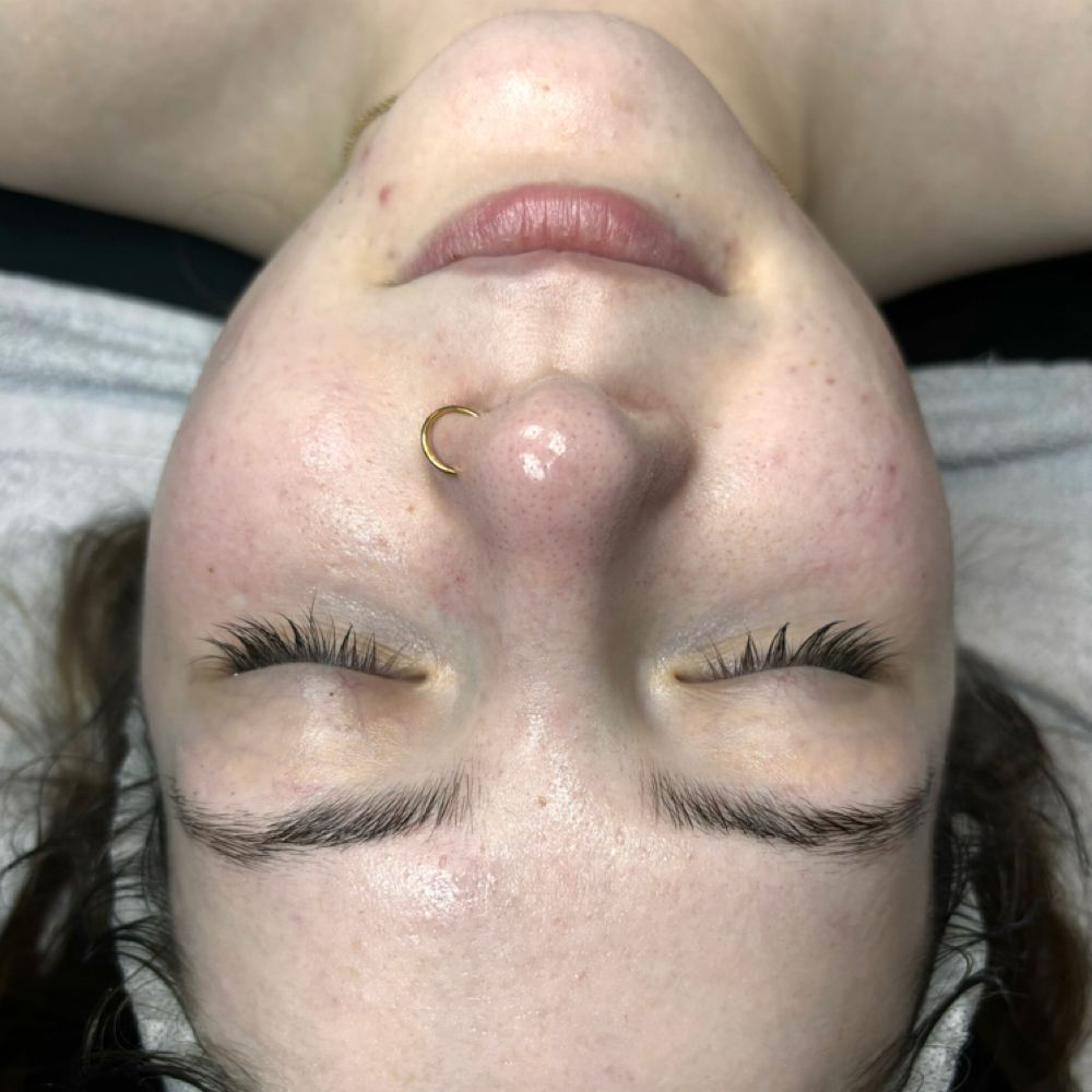 Acne Targeted Facial at Pearly Derm in Sun valley, CA