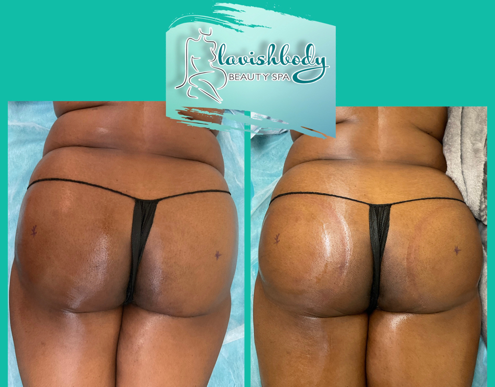 4 Butt Enhancement Sessions