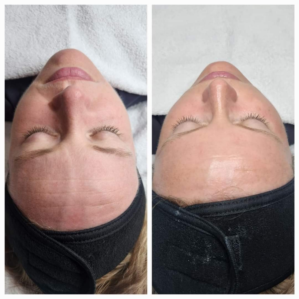 Express Resurfacing Facial