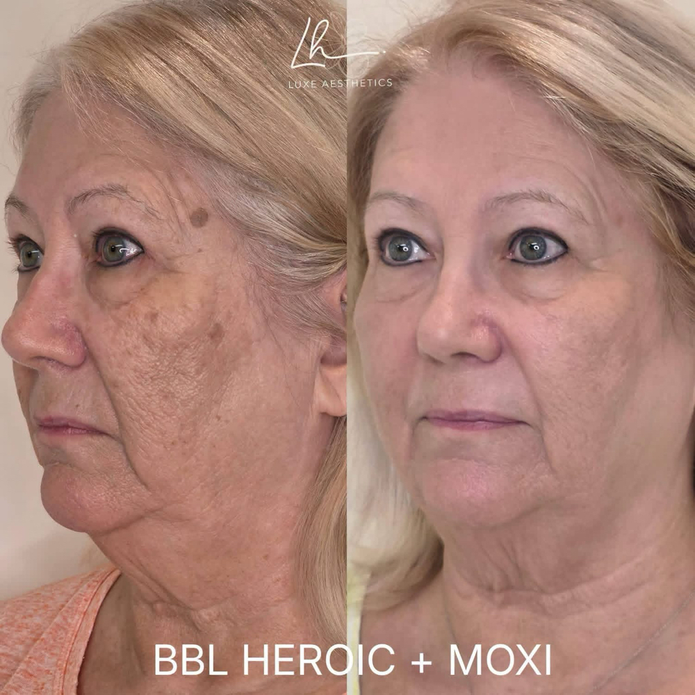 BBL + HERO at ARock Beauty & Wellness in San Angelo, TX