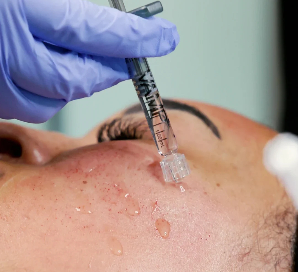 VAMP + JET PLASMA FACIAL