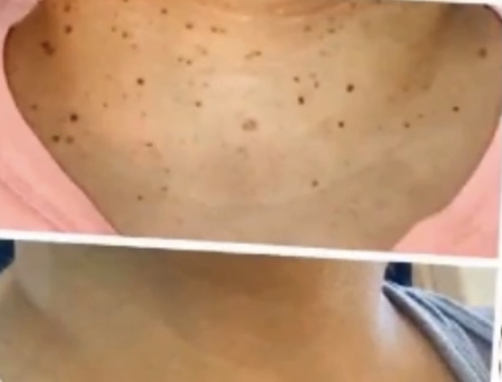 10 Skin Tags