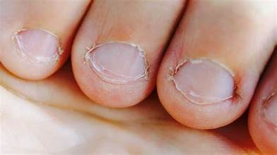 Nail Biter Rebuild Program
