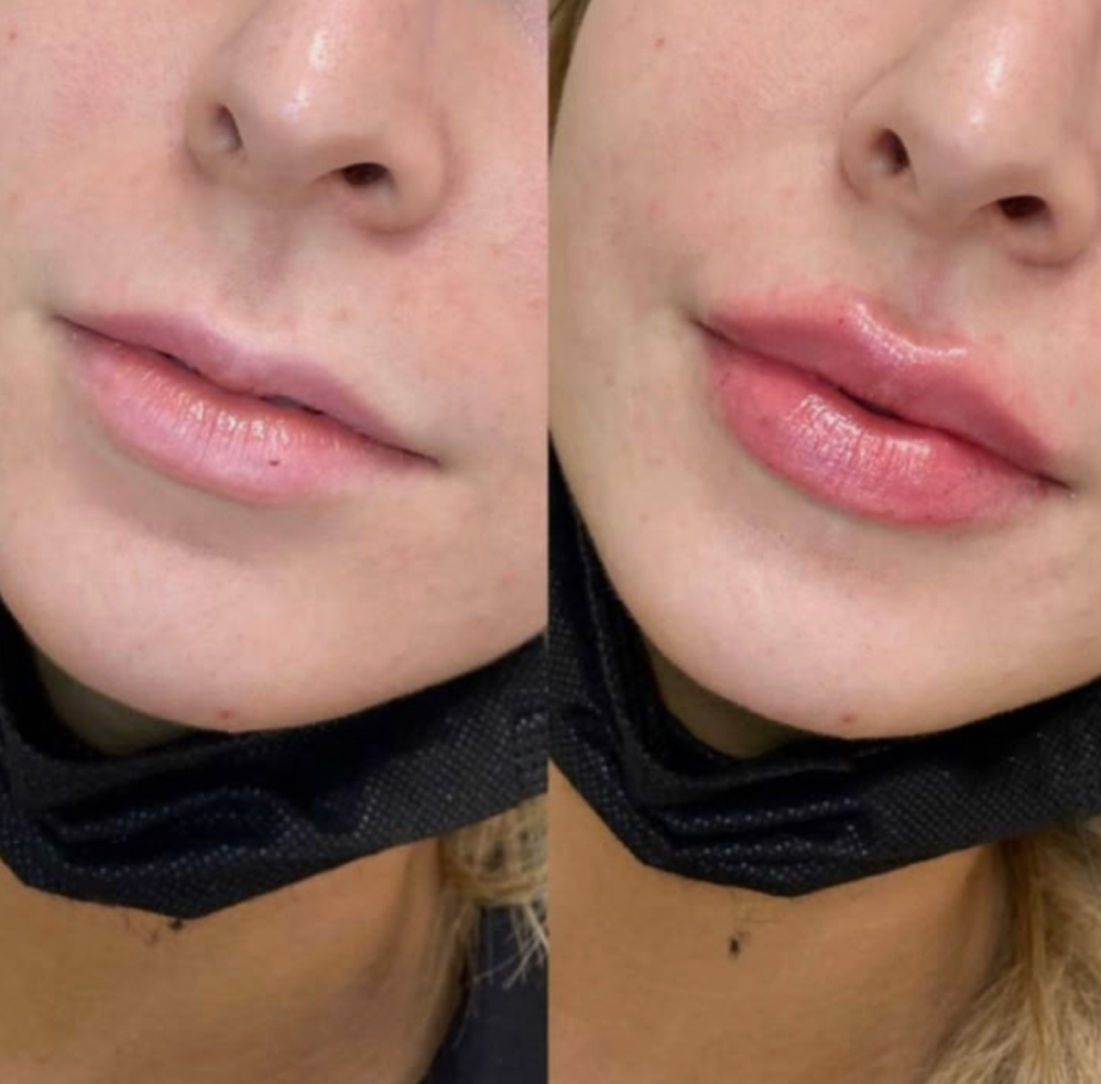 Lip Filler
