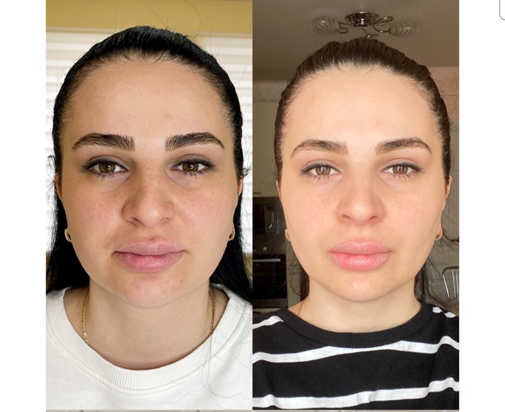 Cold plasma full face+exosom