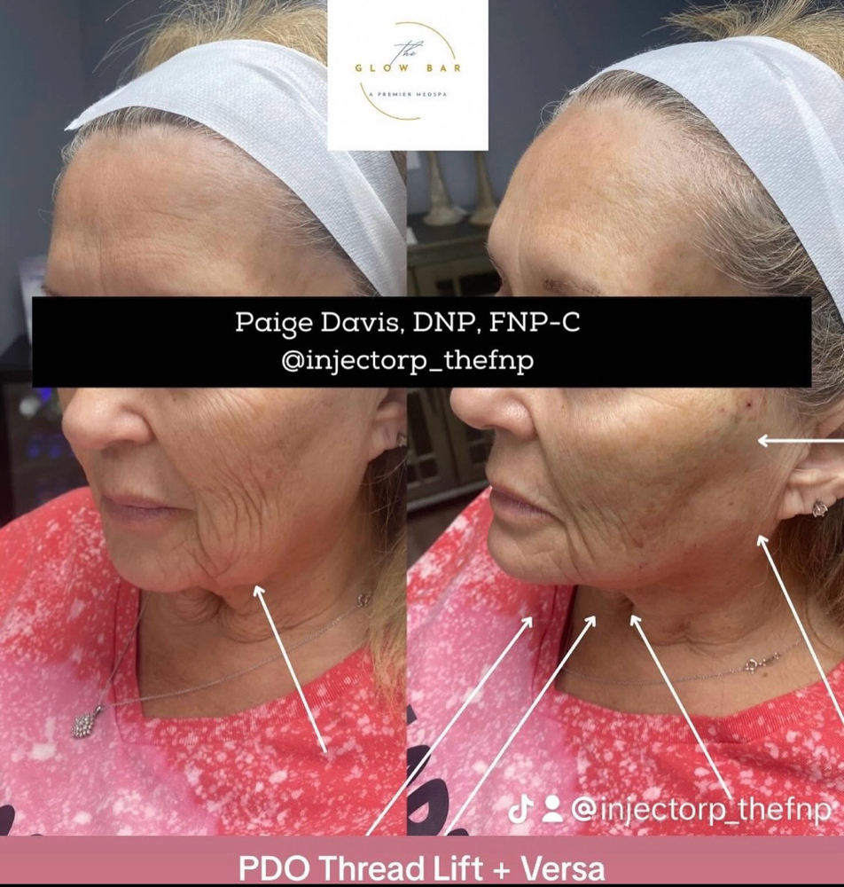 PDO Thread Lift: Lower Face *ADD ON