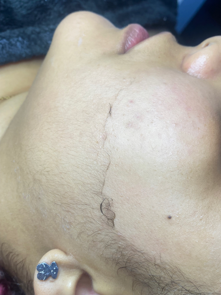 Dermaplaning