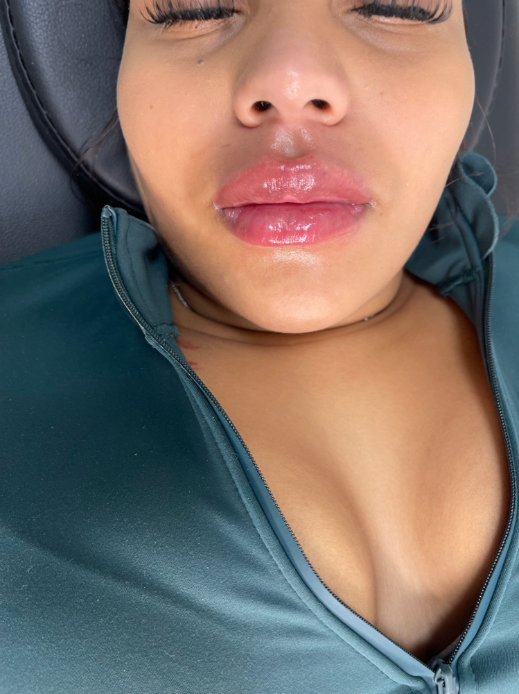 Needleless Lip Fillers