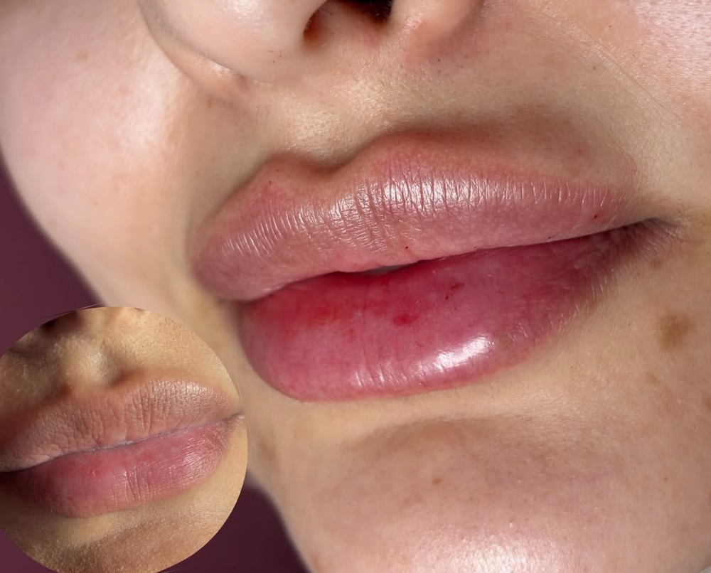 0.7 Syringe Lip Filler at The Beauty Lab DFW in Fort Worth, TX