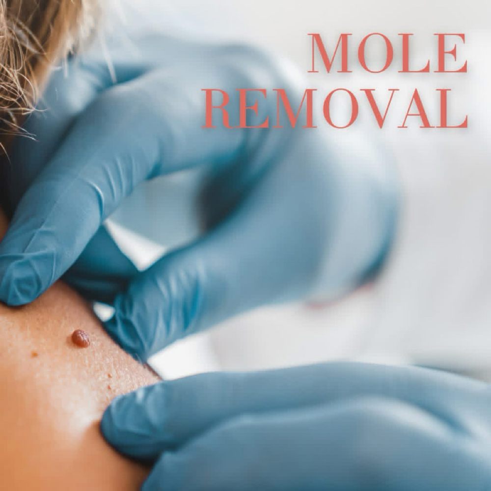 Mole Removal at ARock Beauty & Wellness in San Angelo, TX