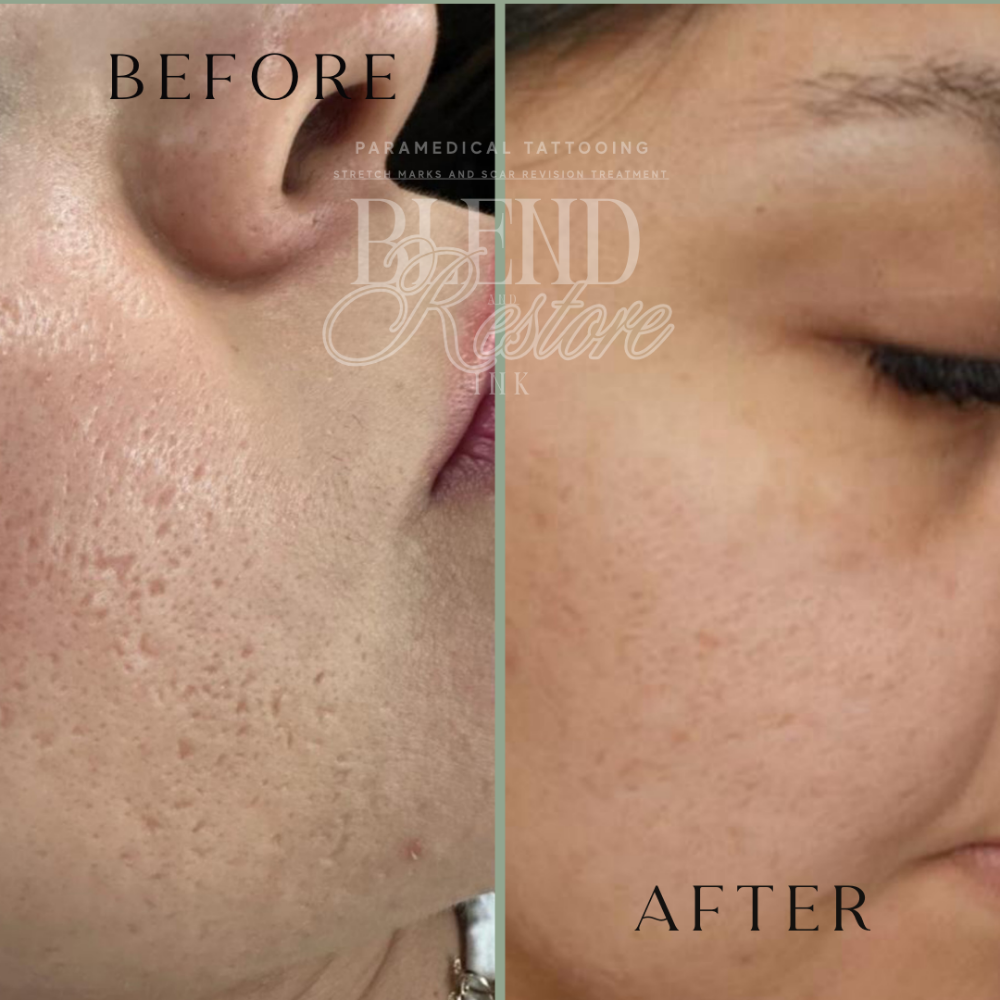 Face acne scars Package