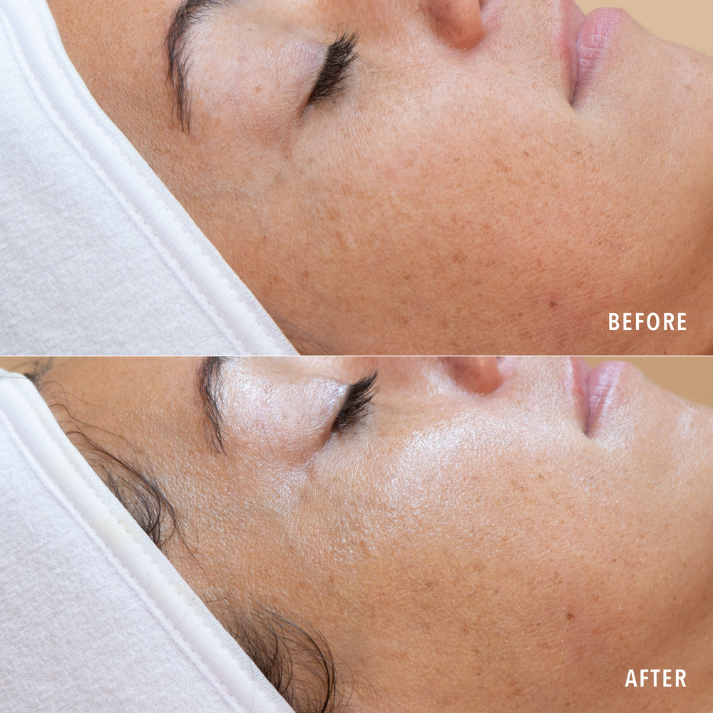 Radiant Skin on Demand at Elan Aesthetics and Wellness in Colorado Springs, CO