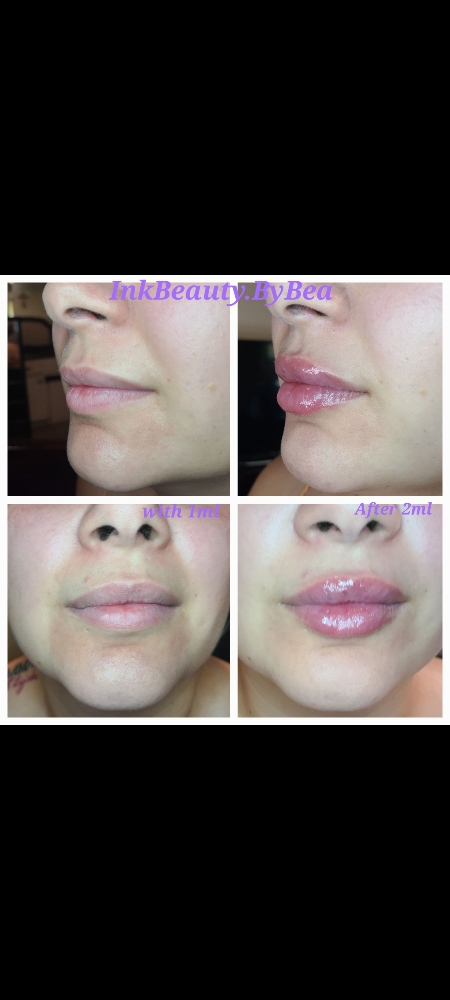 Lip Fillers: Savory Beauty Lip