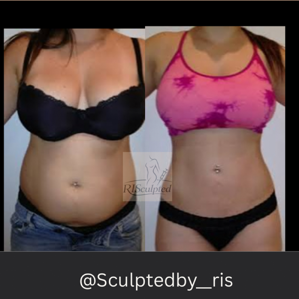 Lipo “Starter” Package at RISculpted Aesthetics in Stockbridge, GA