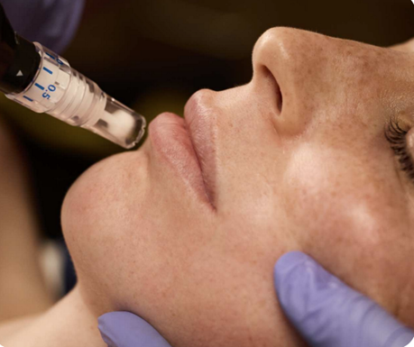 SkinPen Microneedling