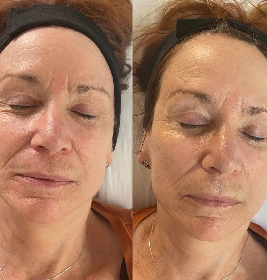 V-Tox + Carboxy Facial