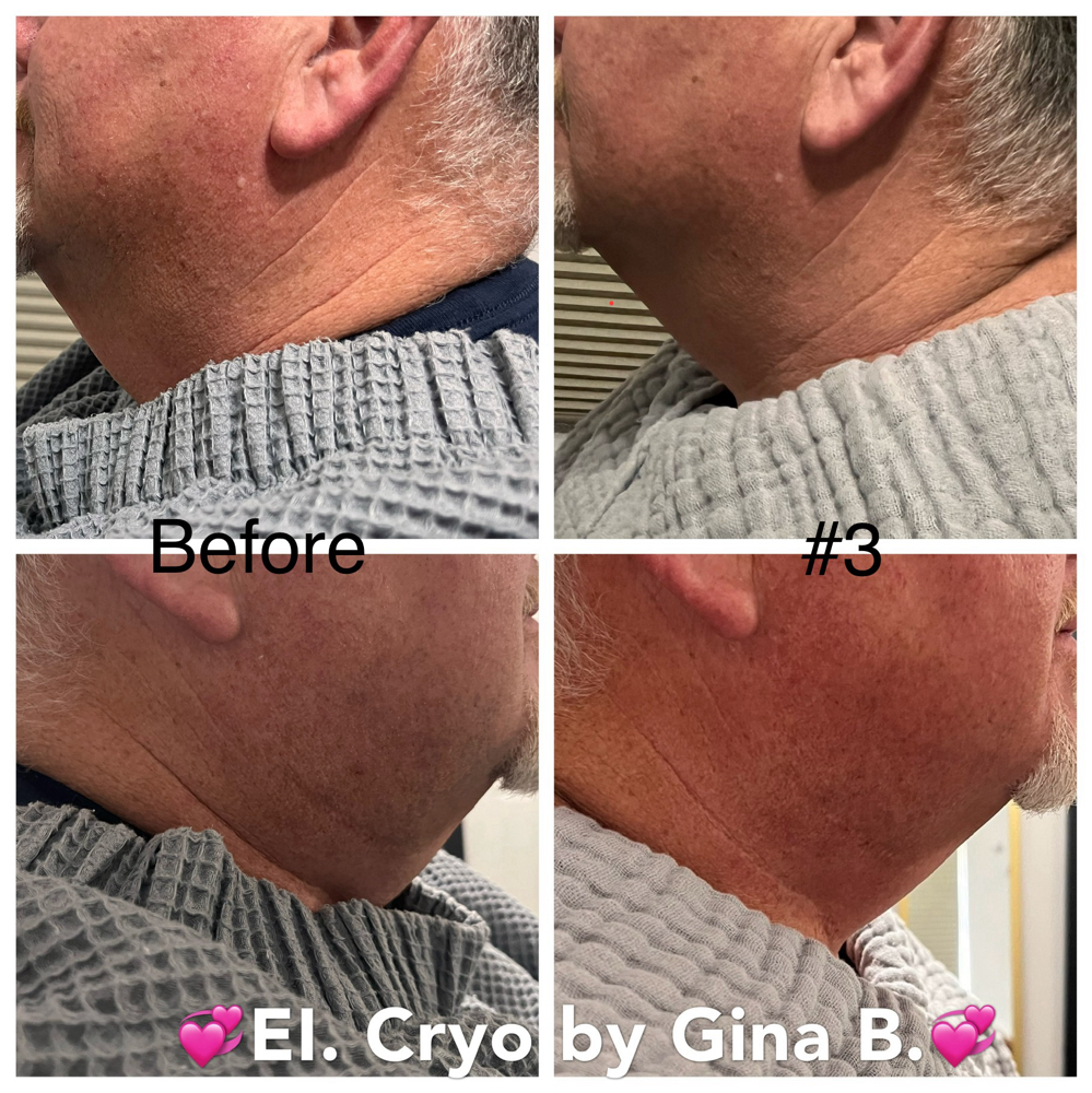 Cryo Collagen Reproduction Consult at Enchanting Image in Cripple Creek, CO