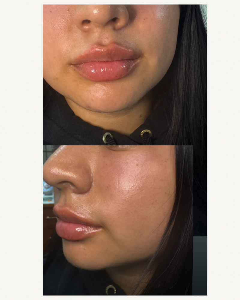 Half Syringe of Lip Filler