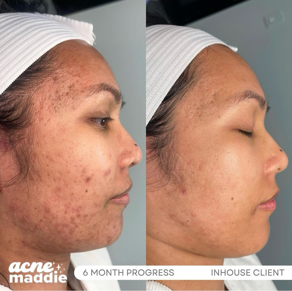 Procell 6 Treatments