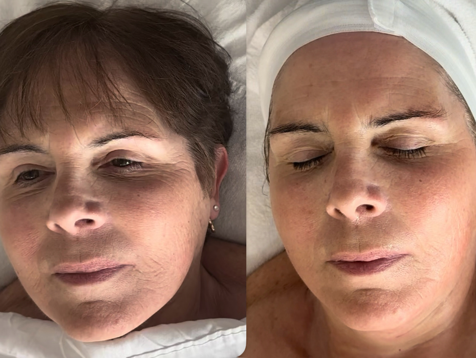 Revive Facial
