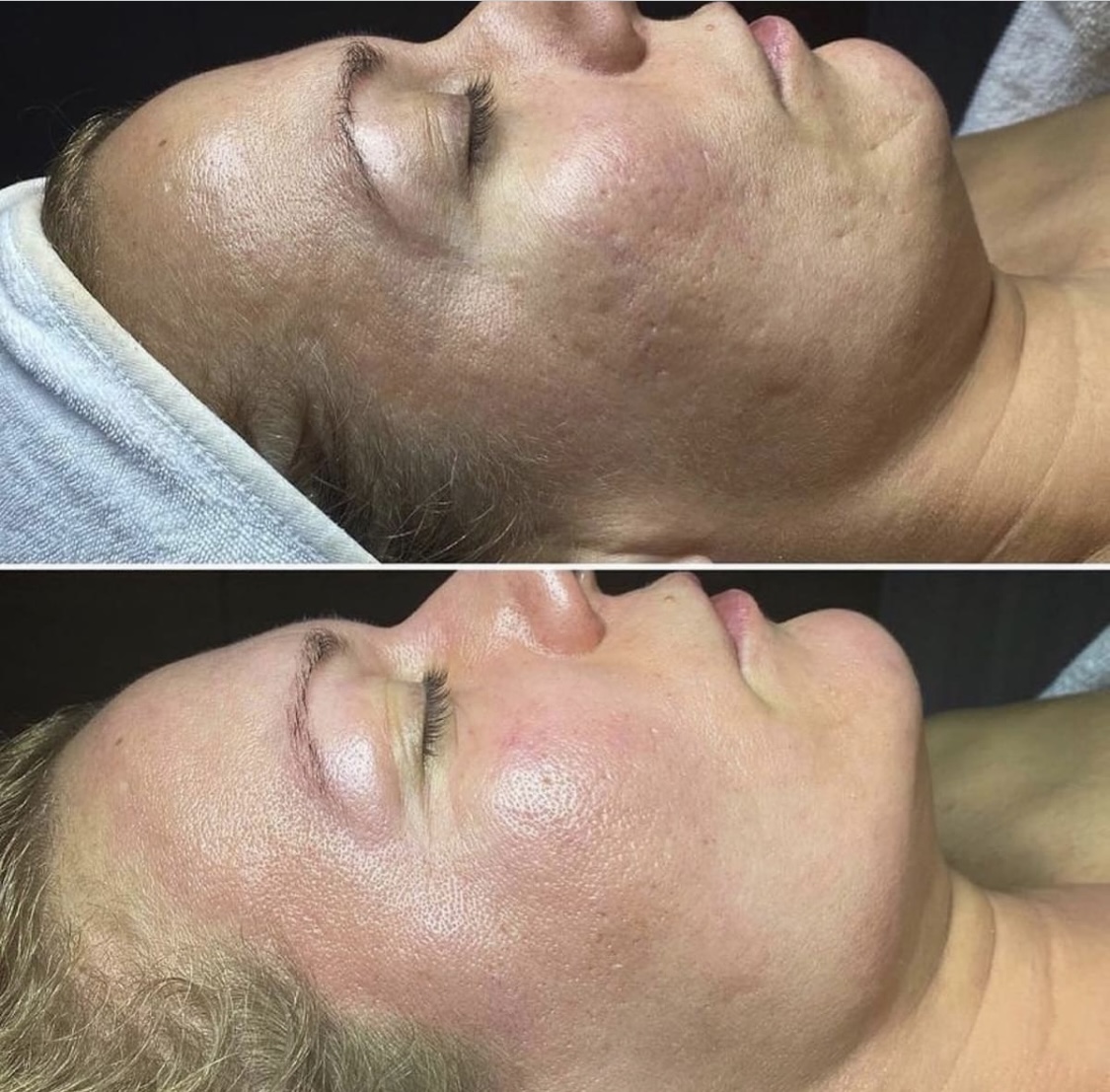 Microneedling and Peel at Plum Artistry & Esthetics, llc. in Peachtree Corners, GA