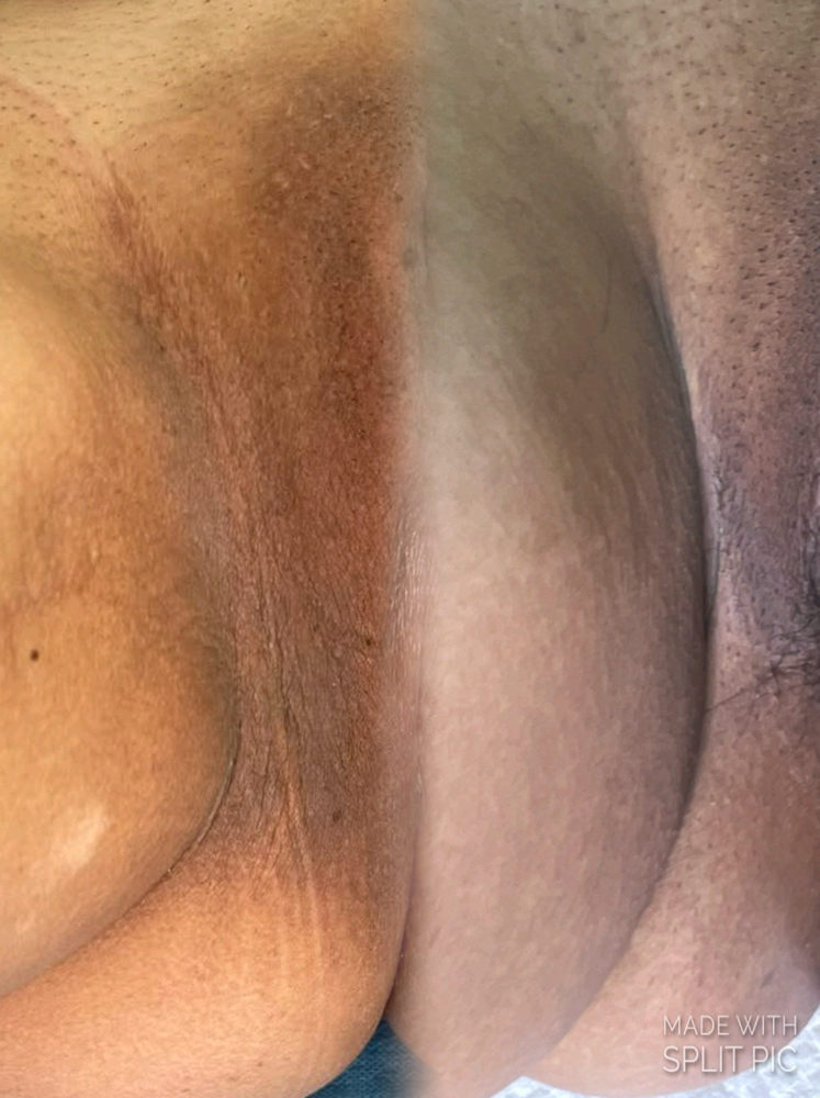 Intimate glow treatment at Adarable Esthetics LLC in Taunton, MA