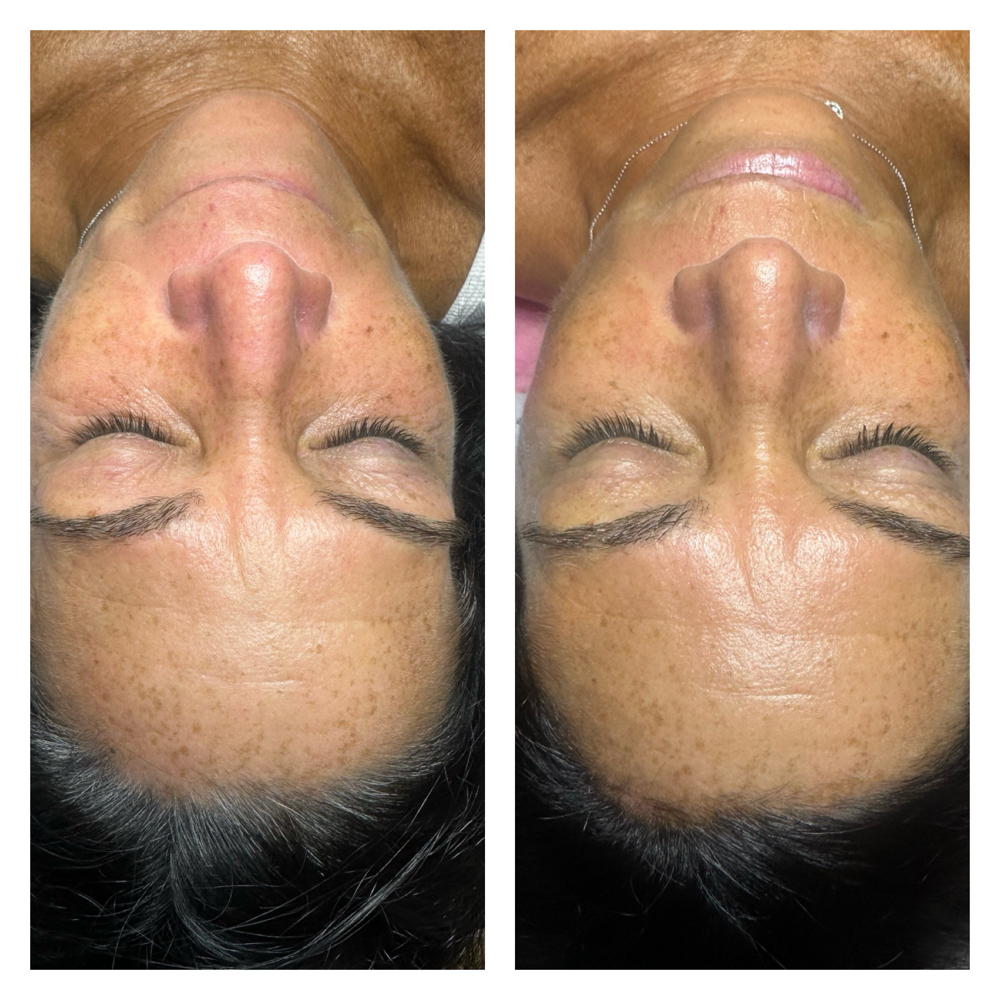 Add Skin Tightening
