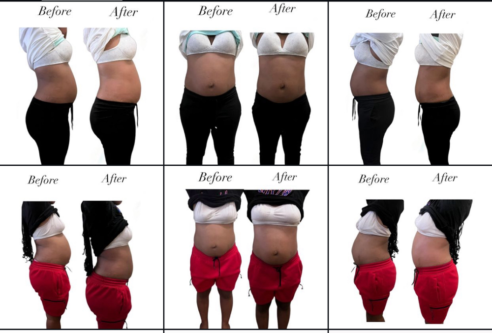 Lipo 360 . Stomach & Back