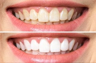 $99 Teeth Whitening