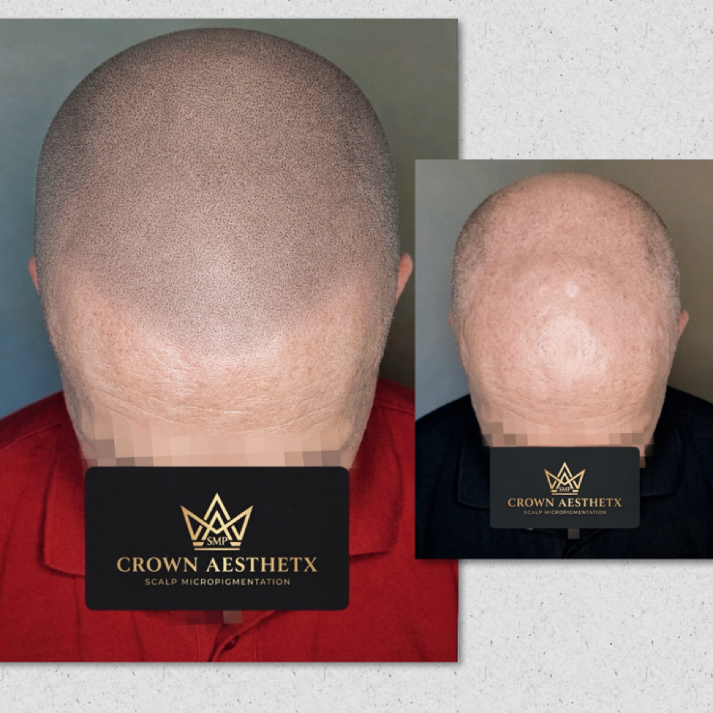 Shaved Head SMP at Crown Aesthetx in Modesto, CA
