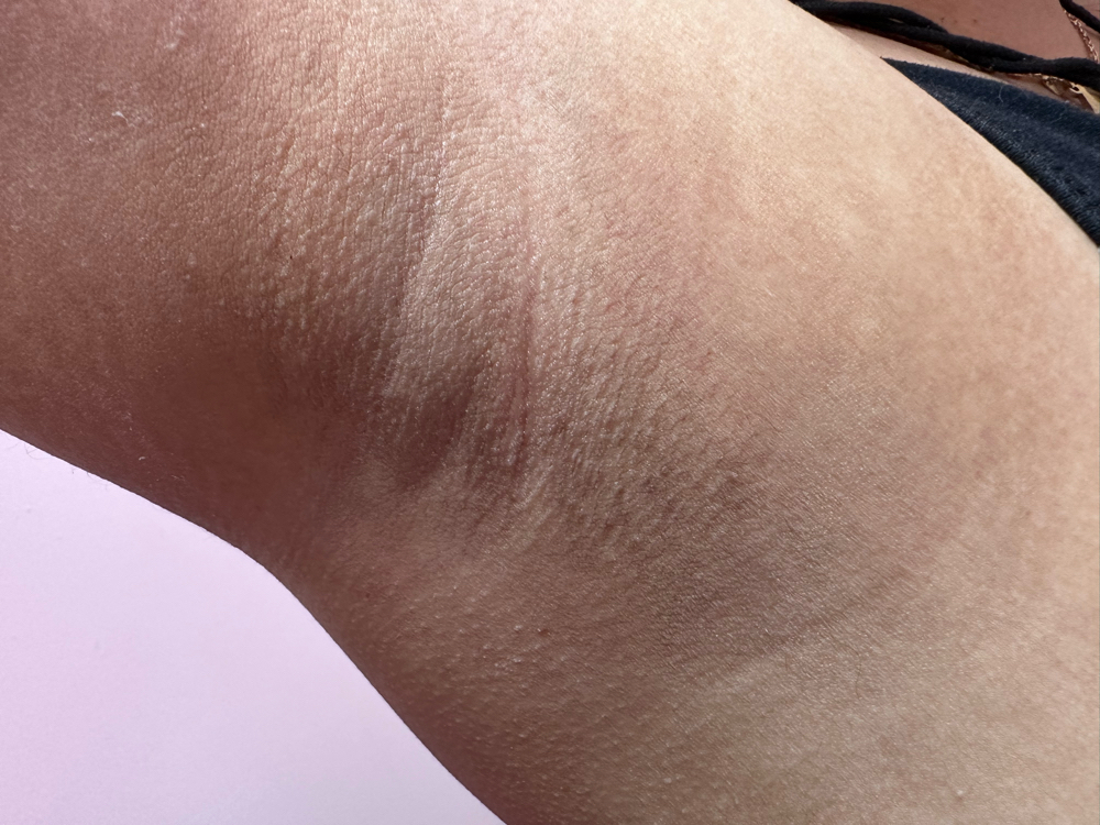 Underarm Sugaring Hair Removal