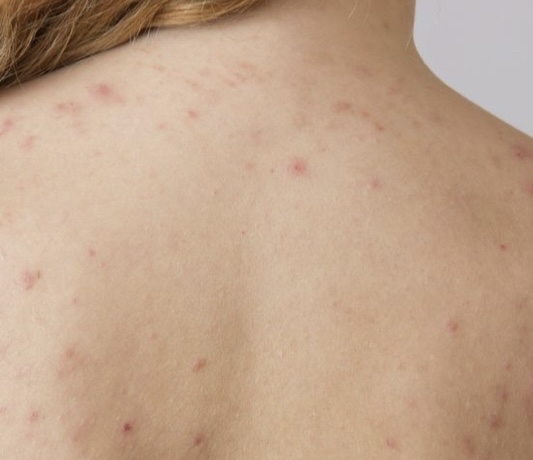 Back Acne Treatment