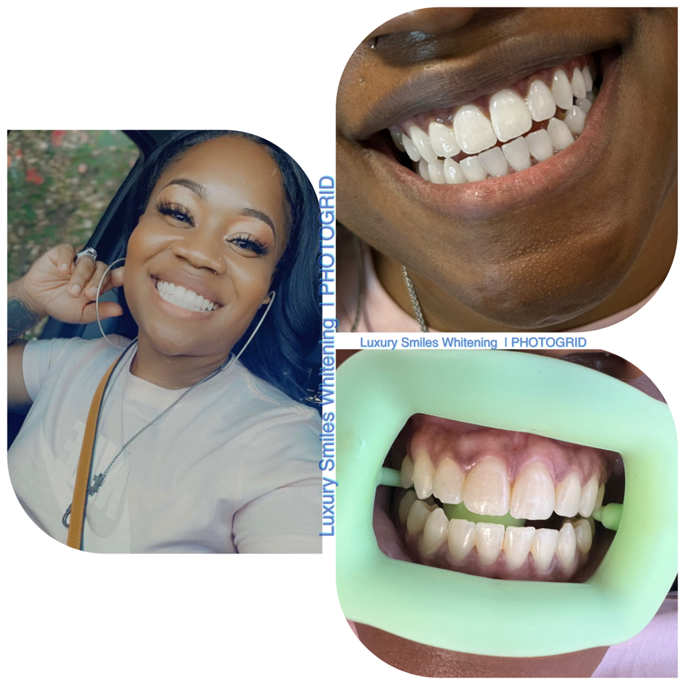 Whitening Touch Up at Luxury Smiles, Waxes & More in Dallas, TX