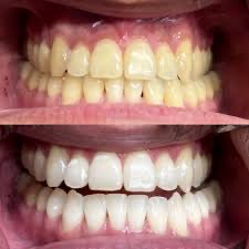 60 Min POWER SMILE
