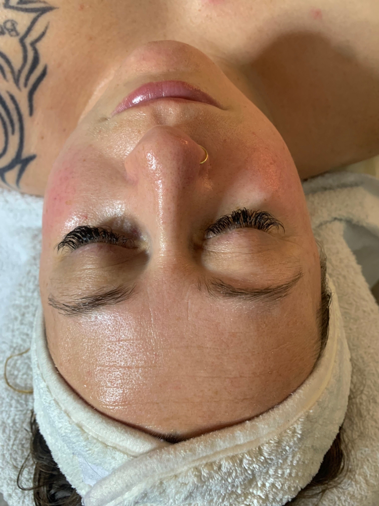 Lactic Acid Peel