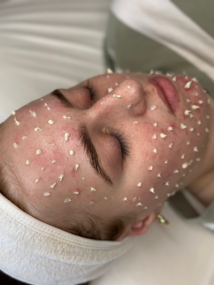 Cellstory Liquid Microneedling