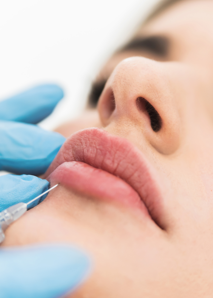 Lip Filler