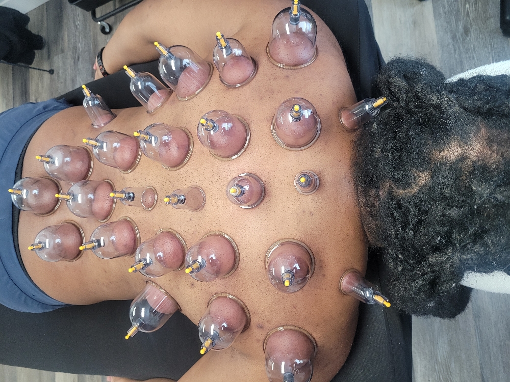 Cupping